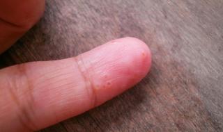 手上起小水泡痒怎么办 手上起小水泡痒怎么办